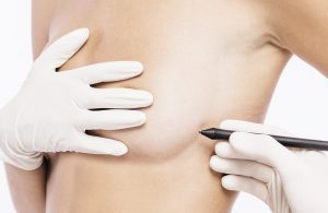 Chirurgie mammaire : Réduction mammaire en Tunisie