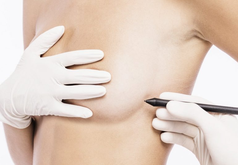 Chirurgie mammaire : Réduction mammaire en Tunisie
