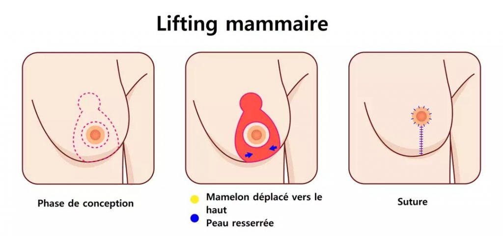 Les étapes d'un lifting mammaire ou lifting des seins