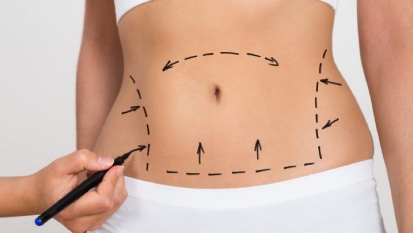 Chirurgie plastique ventre : L'abdominoplastie