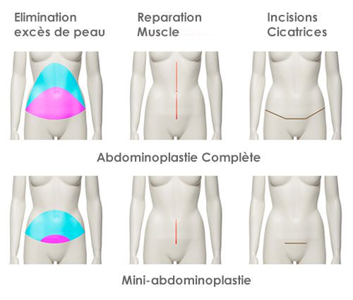 Abdominoplastie :Types et coûts