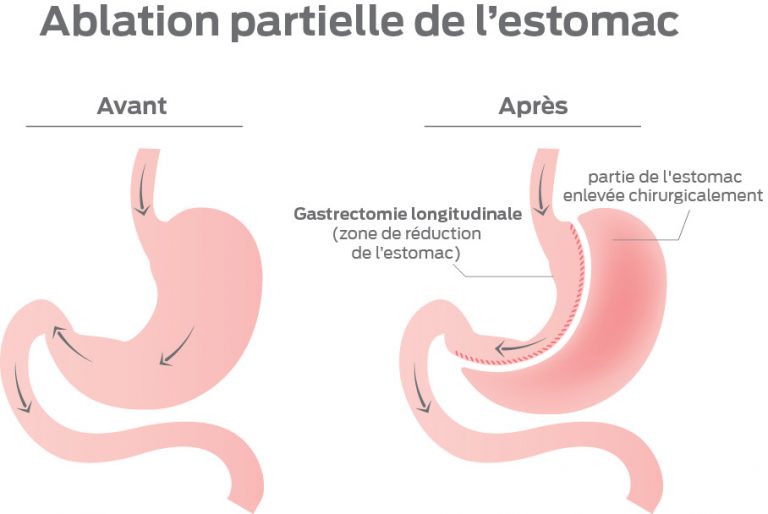 Sleeve gastrique Medcare Vacances